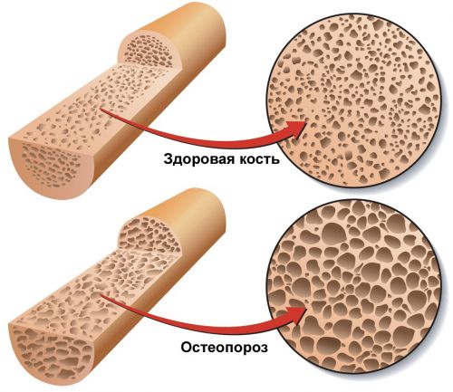 prichina-osteoparoza3