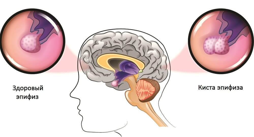 Киста мозг признаки. Киста шишковидной железы симптомы. Кистозная трансформация эпифиза. Фото кисты шишковидной железы головного мозга.