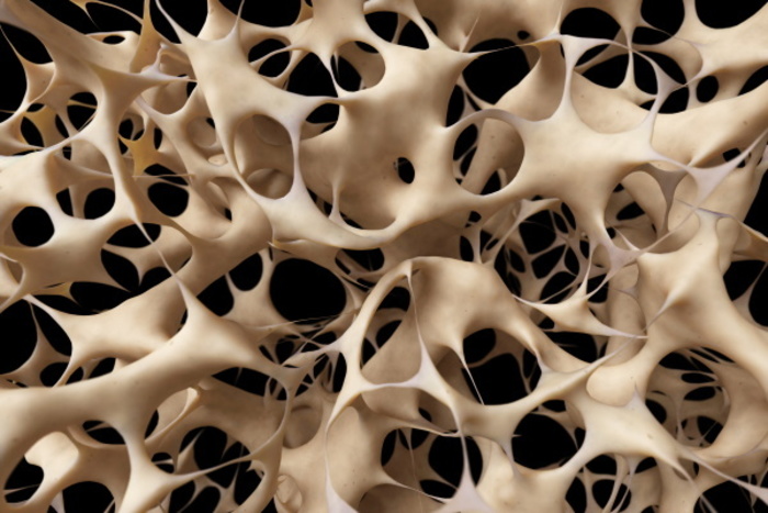 Остеопороз — что это за болезнь и как ее лечить